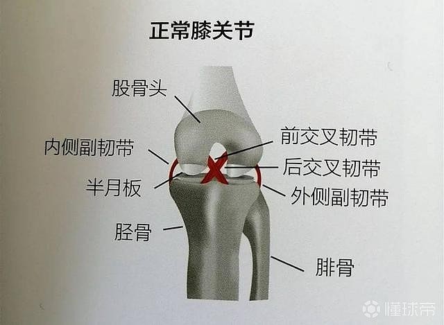 害人无数的十字韧带撕裂，到底是什么样的伤病？ - 2