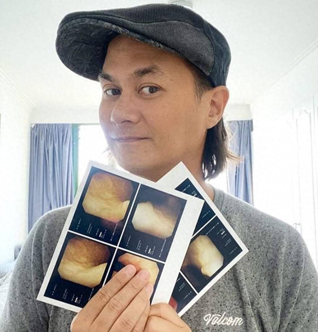 香港知名星二代患膀胱癌,满头白发一脸沧桑,抗癌多年病情稳定 - 1