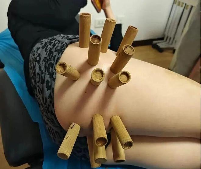 和老婆去按摩店拔罐，现场老惨了：媳妇拔的是要钱我拔的是要命啊 - 2