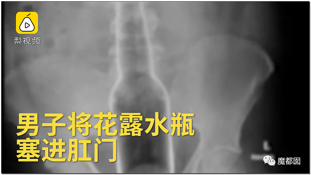 14岁男孩网购假YJ塞GM后整体滑入拿不出来!青少年X教育热议 - 58