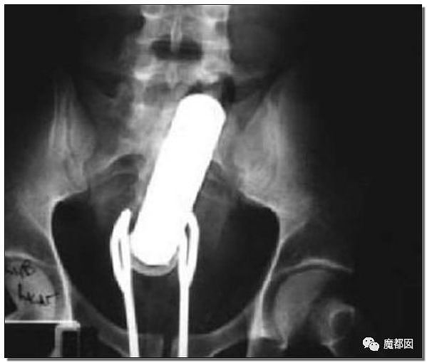 14岁男孩网购假YJ塞GM后整体滑入拿不出来!青少年X教育热议 - 103