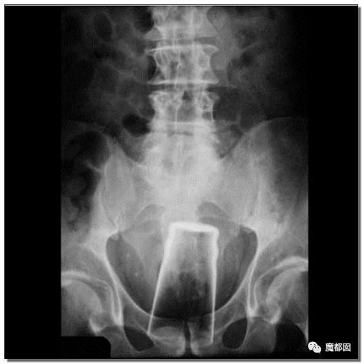 14岁男孩网购假YJ塞GM后整体滑入拿不出来!青少年X教育热议 - 105