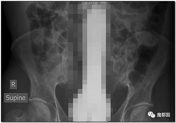 14岁男孩网购假YJ塞GM后整体滑入拿不出来!青少年X教育热议 - 97