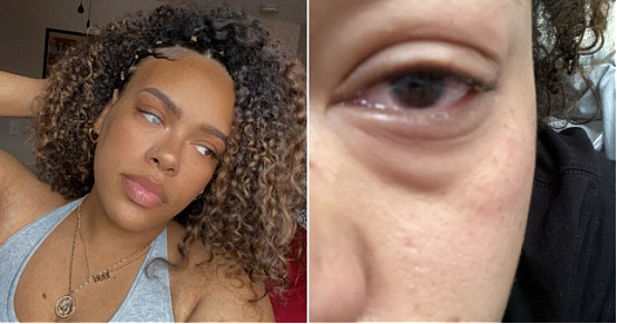 戴美瞳用自来水洗脸竟染寄生虫?全球现多个病例,有人严重到瞎了? - 9