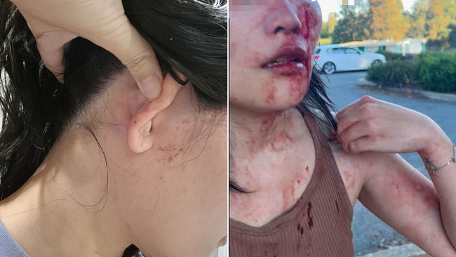 堪培拉发生恶性伤人！27岁华女遭暴打满脸血，中使馆敦促澳警彻查 - 3