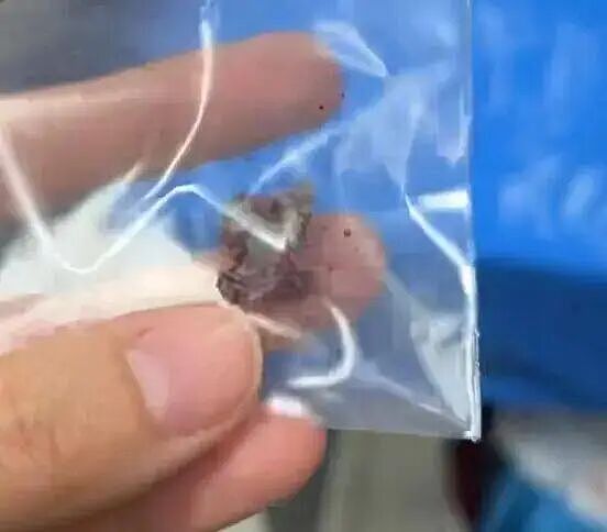 惨烈！中国女游客泰国中弹：子弹穿脸而过，打掉多颗牙齿卡在舌头上（组图） - 3