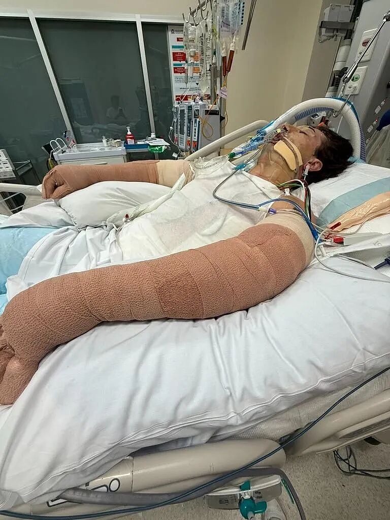 家中常用物品突然爆炸，澳洲男子全身75%烧伤！消防：平均每周3起火灾由它而起 - 4