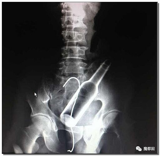 14岁男孩网购假YJ塞GM后整体滑入拿不出来!青少年X教育热议 - 102