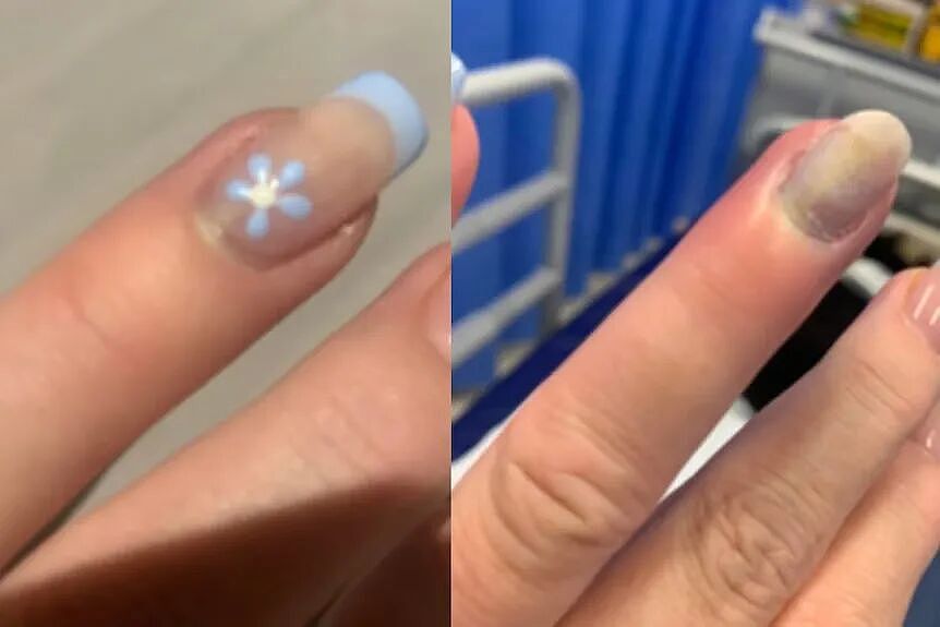 就因为进了一趟美甲店,澳女染上败血症!脚差点没了(组图) - 3