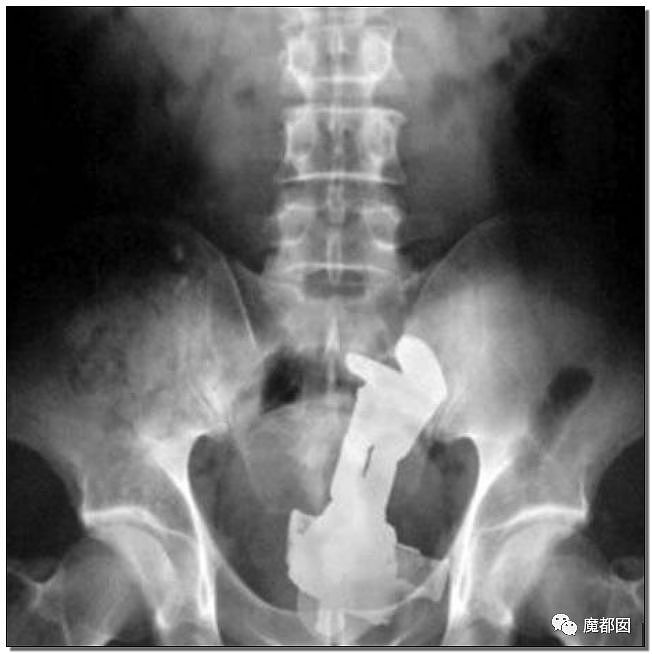 14岁男孩网购假YJ塞GM后整体滑入拿不出来!青少年X教育热议 - 123