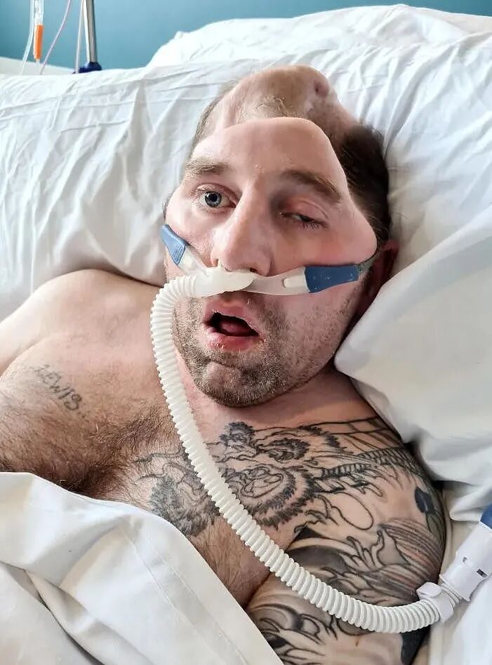 他被打一拳,半个头骨没了!7年生不如死,凶手只判15个月...这?!(组图) - 3