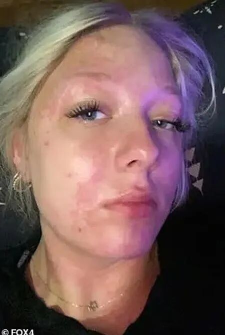 16岁女孩在家洗个澡,被自来水化学烧伤了?水黑得像可乐,当地却把曝光的记者抓了...(组图) - 1