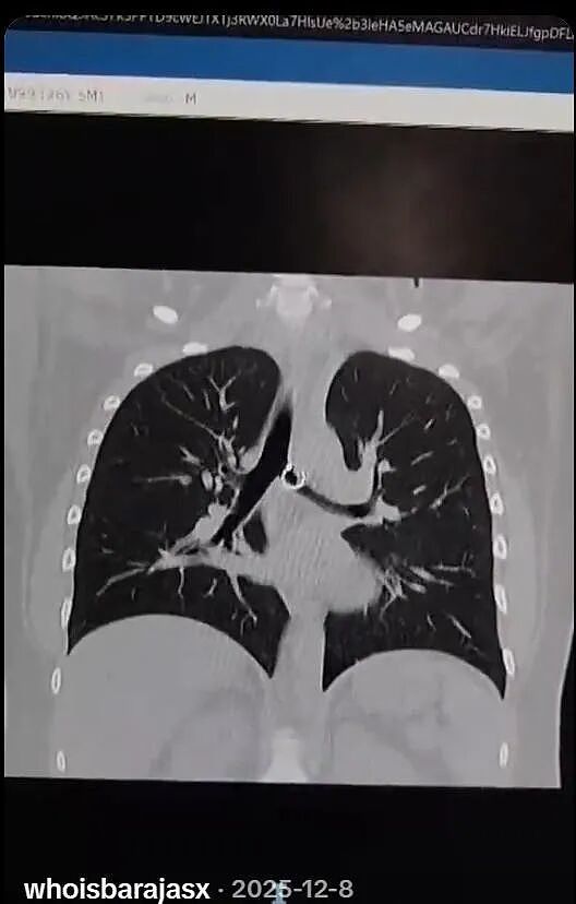 妹子连咳一个月,最后在肺里找到丢失的鼻环?离大动脉0.5毫米,差点挂了...(组图) - 7