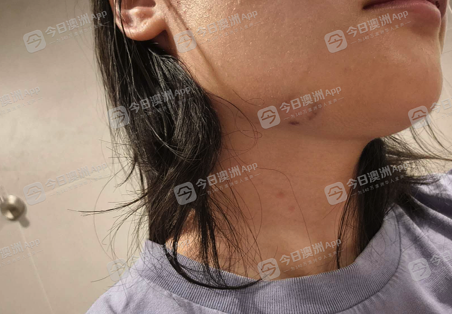 愤怒！澳洲华女遇种歧辱骂，被暴打至浑身是血，由救护车送院！悍妇更持刀威胁，一走了之 - 4
