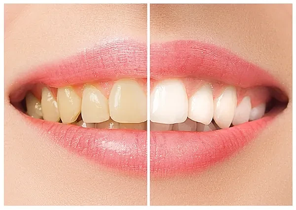 为什么大多数美白牙膏没效果？专业牙医解密7大牙齿美白方法