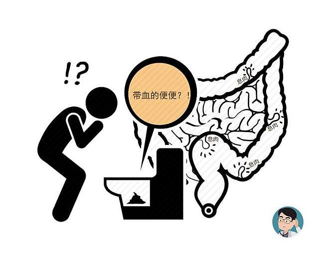 肠内有癌，排便告知？若满足4个特征，或许是肠癌！再忽视就晚了