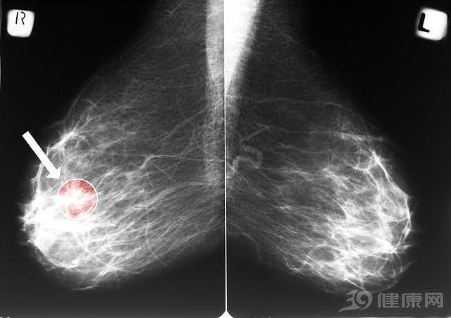 肺结节、乳腺结节、甲状腺结节：体检上的结节，离癌症还有多远？