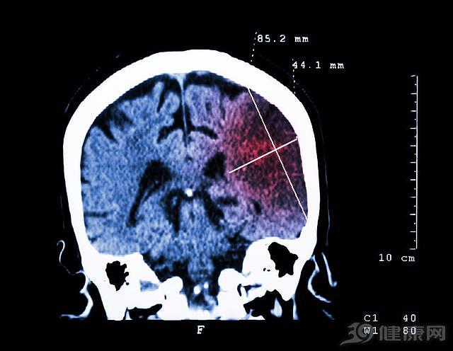 神经内科医生忠告：脑梗的祸根找到了，要远离关键危险因素
