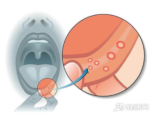 长期口腔溃疡要警惕癌变，病灶有这4个特点，最好去医院检查一下