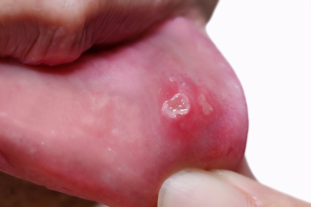 口腔有癌，舌头先知？舌头这种现象，很多人都错认为是口腔溃疡