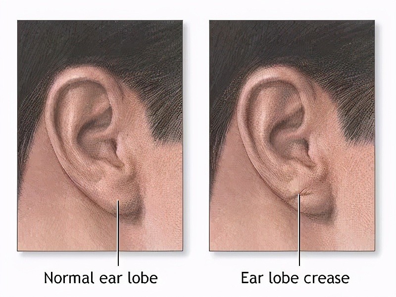 耳朵上有这条折痕，需要警惕心梗猝死来临？快看看你有没有