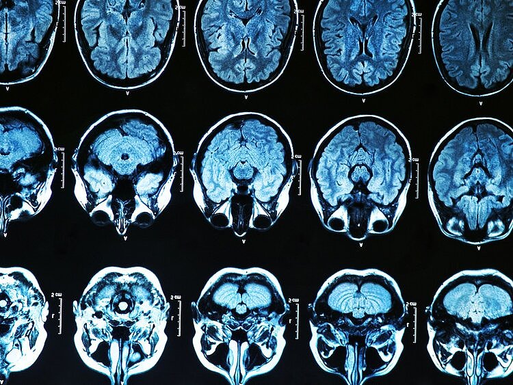 CT、磁共振报告上的“脑萎缩”是什么？或是3种病引起，要留心