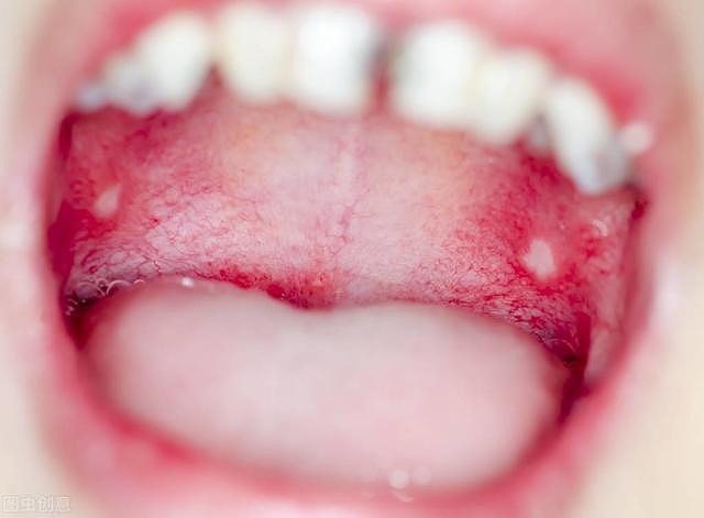 有一种痛，叫口腔溃疡，医生提醒：5个办法减少溃疡疼，促进愈合