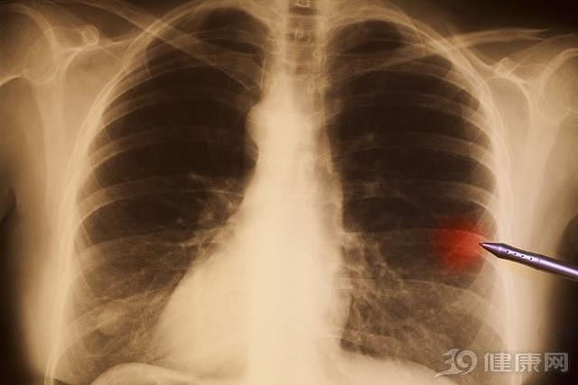 要当心这类咳嗽，早期肺癌传出的第一个高危信号，太容易被忽视！