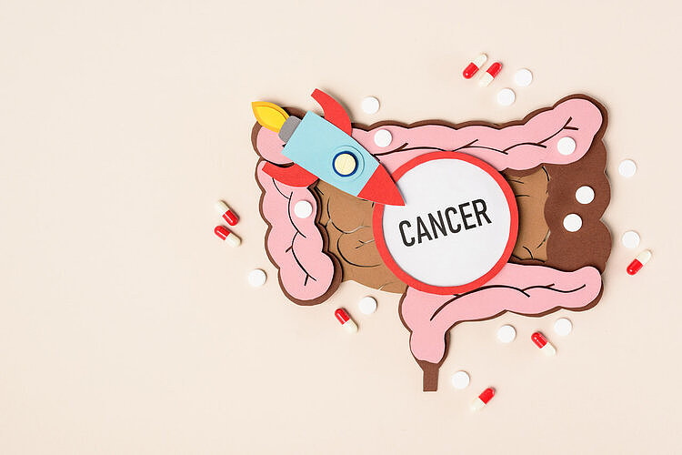 每年28万人死于肠癌！已证实：身上2个指标，或可预测肠癌风险