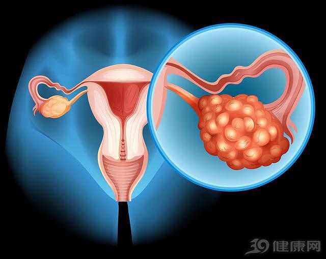 妇科医生多次劝告女人：预防卵巢癌，有4点一定要重视
