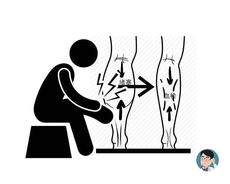 双腿最易“藏”血栓！腿部的5种“不适”，提醒你：血管被堵了