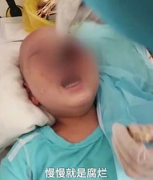 痛心！济南6岁幼童患白血病，被罕见病菌“吃掉”半张脸