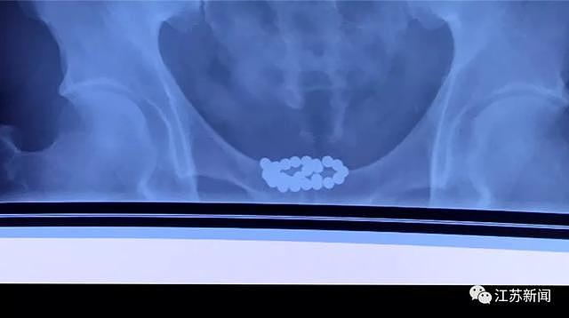 尴尬！29颗磁力珠塞入尿道，男子强忍十几天求医：表面已经钙化