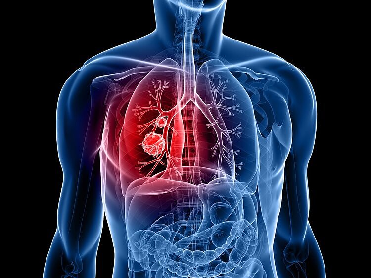 体检中心恶性肿瘤数据：肺癌是头号杀手！专家：三大症状不能拖
