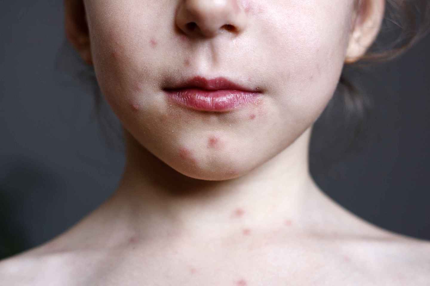 19岁女孩挤痘引发颅内感染：这个部位的挤痘痘，等于“玩命”