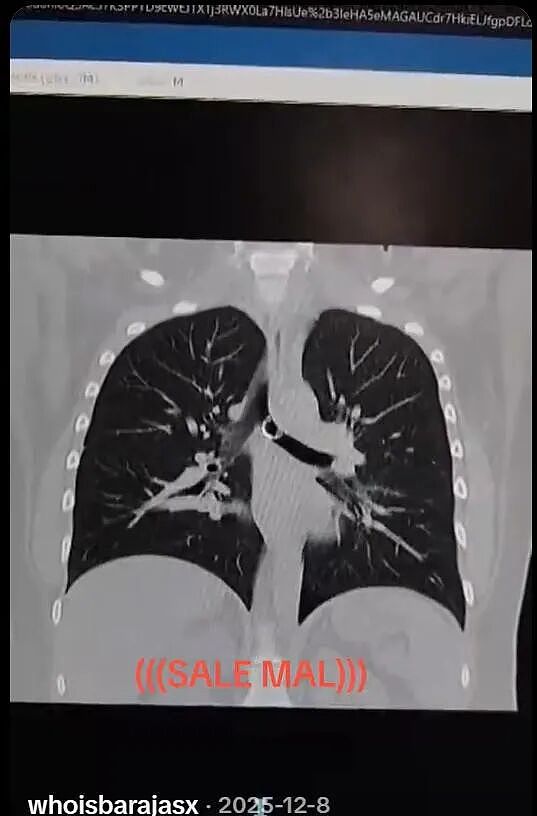 妹子连咳一个月,最后在肺里找到丢失的鼻环?离大动脉0.5毫米,差点挂了...(组图) - 3