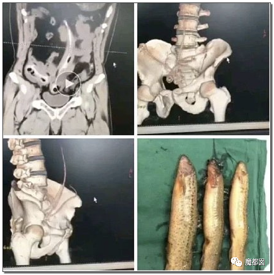 14岁男孩网购假YJ塞GM后整体滑入拿不出来!青少年X教育热议 - 72