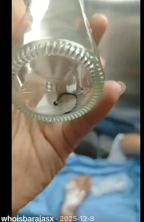 妹子连咳一个月,最后在肺里找到丢失的鼻环?离大动脉0.5毫米,差点挂了...(组图) - 6
