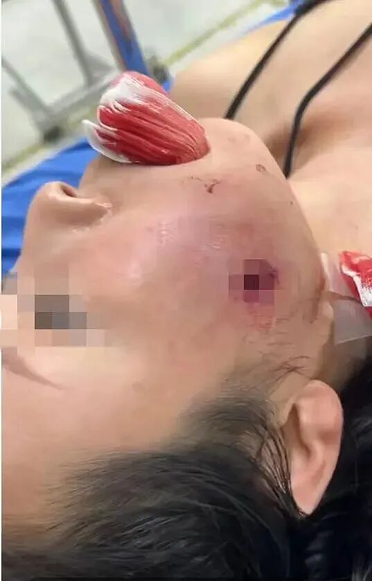 中国女游客泰国普吉岛遭流弹击中:母亲面部中弹,女儿异国求助维权(组图) - 2