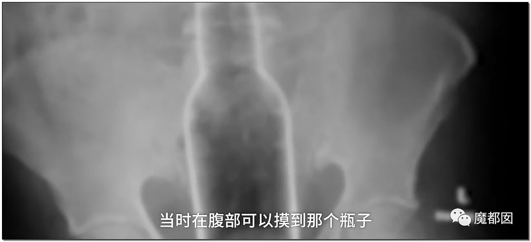 14岁男孩网购假YJ塞GM后整体滑入拿不出来!青少年X教育热议 - 59
