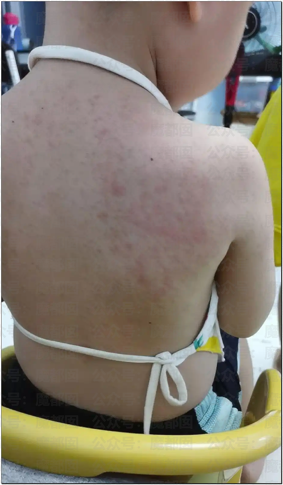 震撼！竟然不是所有人都能吃蚕豆！可能严重到溶血死亡（组图） - 10