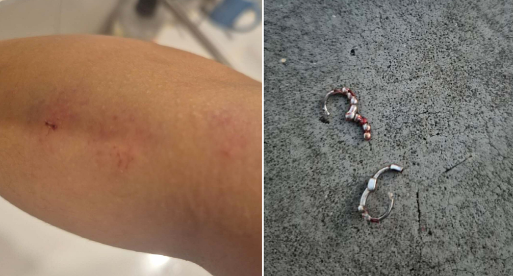 澳洲23岁华女市中心遭种族袭击，被两人殴打！“指甲断裂，脑震荡”（组图） - 11