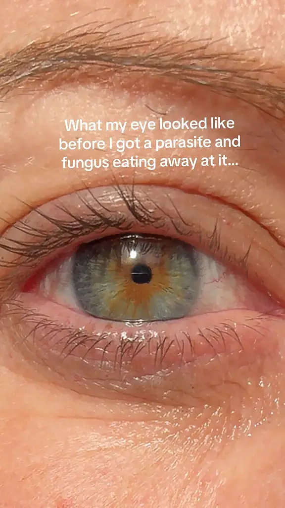 戴美瞳用自来水洗脸竟染寄生虫?全球现多个病例,有人严重到瞎了? - 2