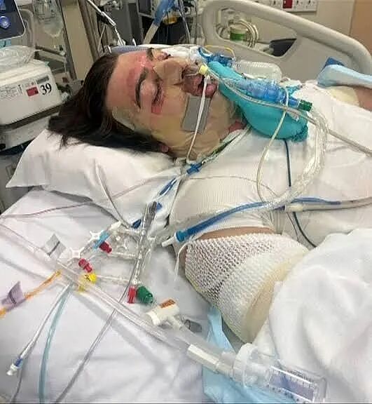 家中常用物品突然爆炸，澳洲男子全身75%烧伤！消防：平均每周3起火灾由它而起 - 3