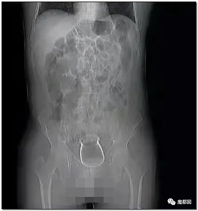 14岁男孩网购假YJ塞GM后整体滑入拿不出来!青少年X教育热议 - 68