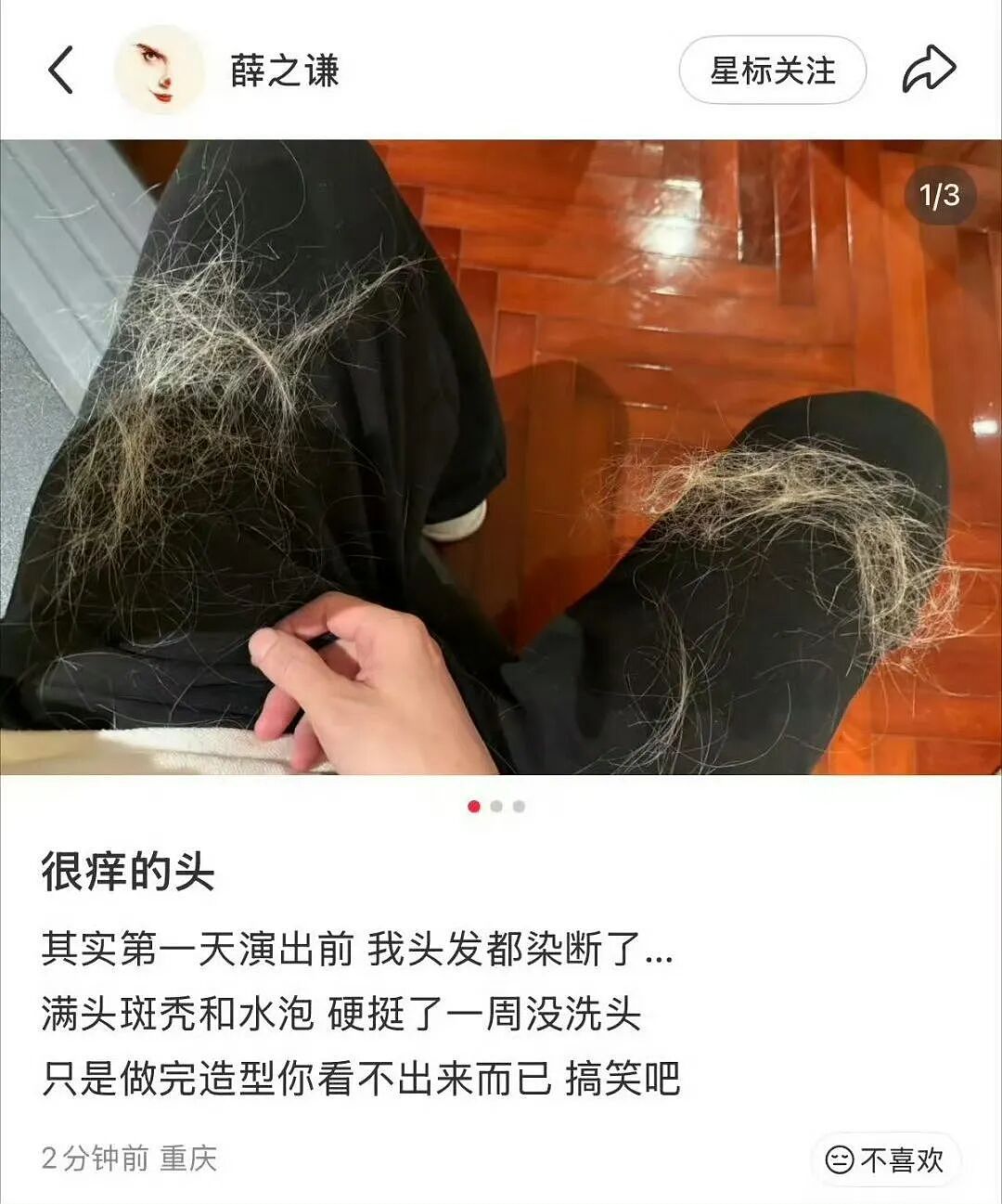 薛之谦晒满头水泡和斑秃,医生警告:再这么染就真没了(组图) - 1