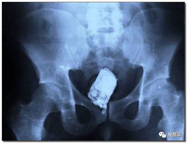 14岁男孩网购假YJ塞GM后整体滑入拿不出来!青少年X教育热议 - 107