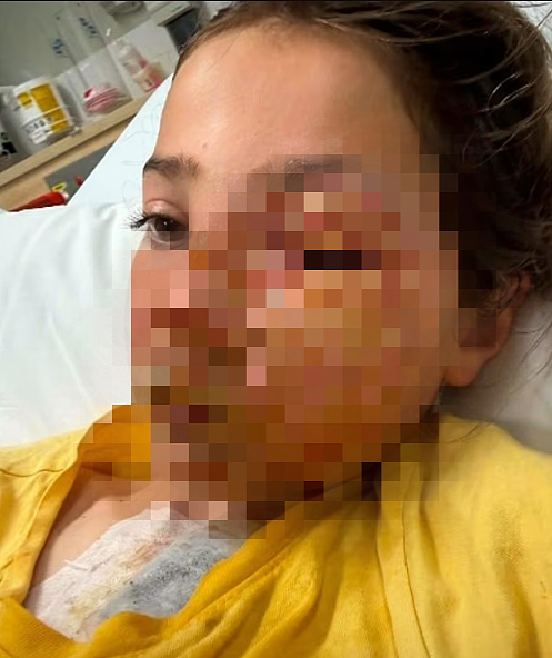 差点毁容！澳洲10岁女孩被流行玩具害惨！爸爸紧急警告！全澳已有多名受害者（组图） - 4