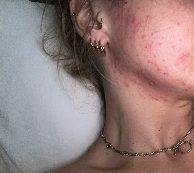 导致维州多人遭肝损害,当局呼吁停用一款药物 - 4