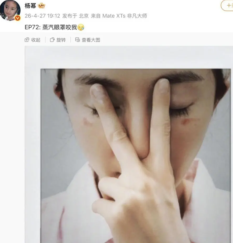 杨幂晒照,脸被烫伤!张馨予留言:我也被烫过 - 1